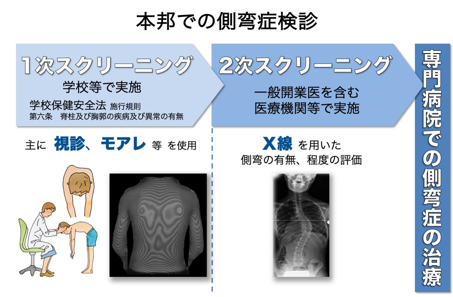 本邦での側弯症検診